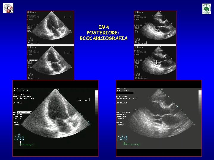 IMA POSTERIORE: ECOCARDIOGRAFIA 