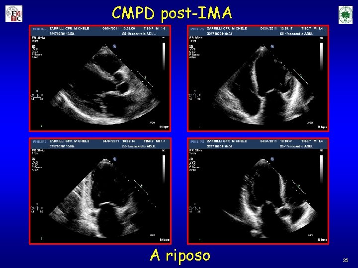 CMPD post-IMA A riposo 25 CMPD post-IMA A riposo 25