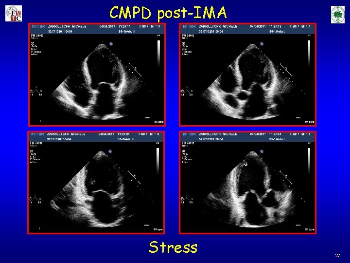 CMPD post-IMA Stress 27 