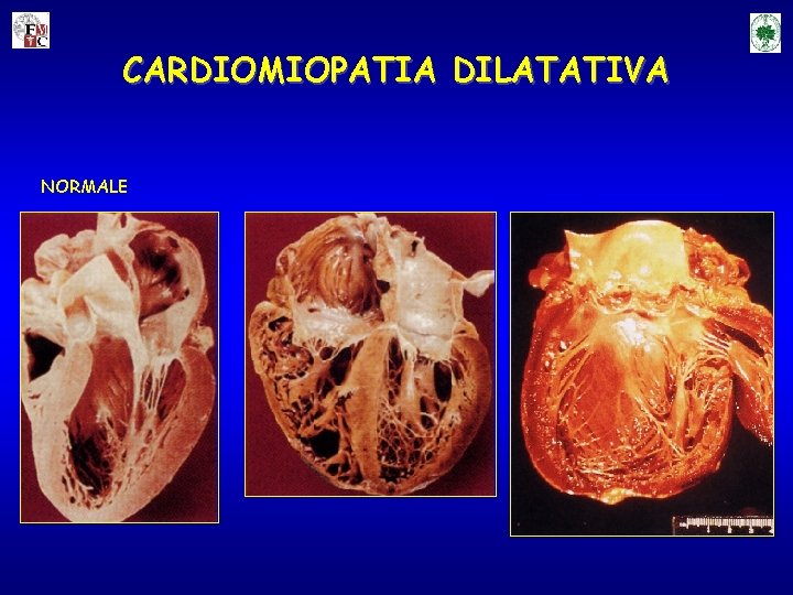 CARDIOMIOPATIA DILATATIVA NORMALE 