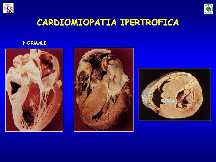 CARDIOMIOPATIA IPERTROFICA NORMALE 