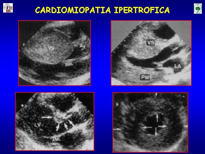 CARDIOMIOPATIA IPERTROFICA 