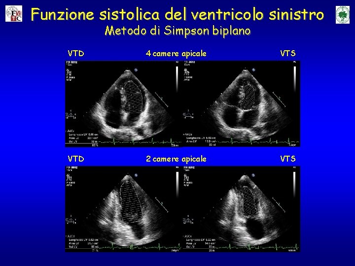 Funzione sistolica del ventricolo sinistro Metodo di Simpson biplano VTD 4 camere apicale VTS Funzione sistolica del ventricolo sinistro Metodo di Simpson biplano VTD 4 camere apicale VTS