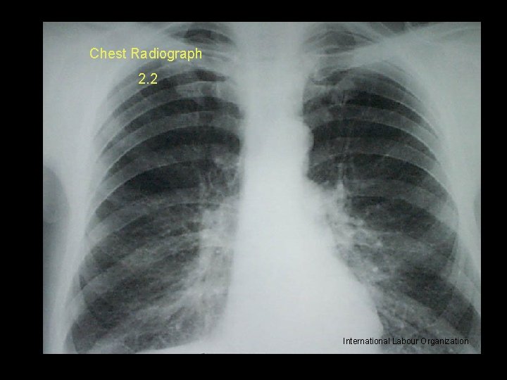 Chest Radiograph 2. 2 International Labour Organization 