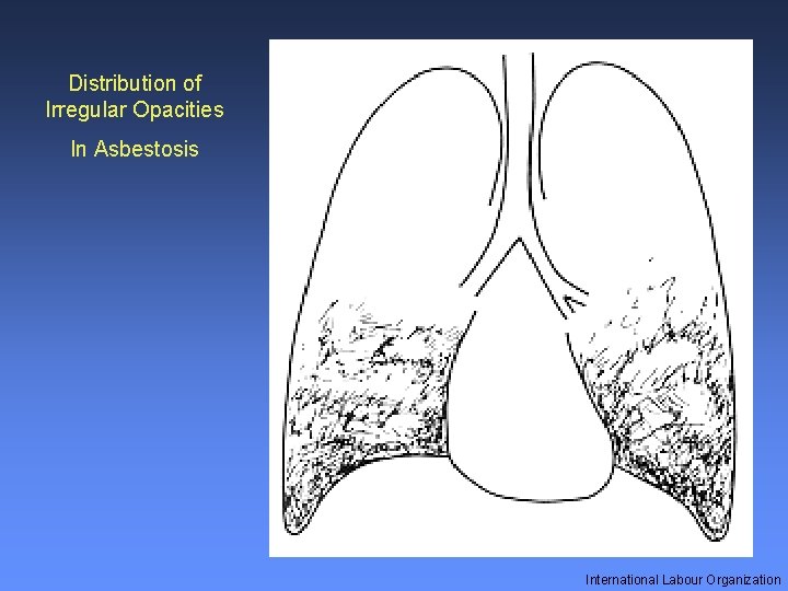 Distribution of Irregular Opacities In Asbestosis International Labour Organization 