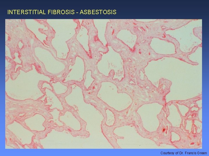 INTERSTITIAL FIBROSIS - ASBESTOSIS Courtesy of Dr. Francis Green 