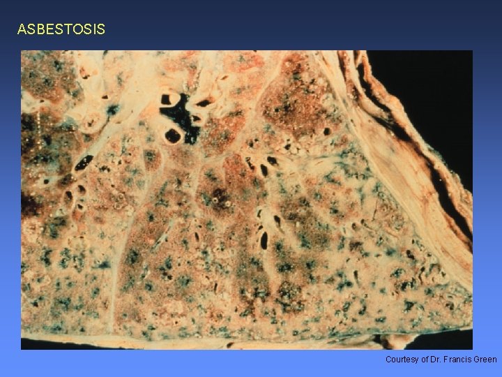 ASBESTOSIS Courtesy of Dr. Francis Green 