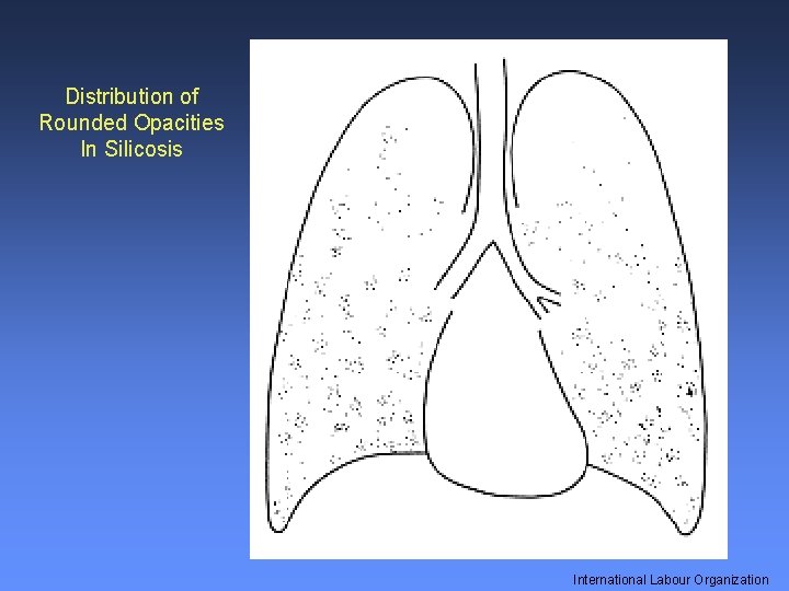 Distribution of Rounded Opacities In Silicosis International Labour Organization 