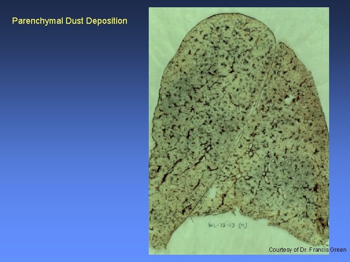 Parenchymal Dust Deposition Courtesy of Dr. Francis Green 