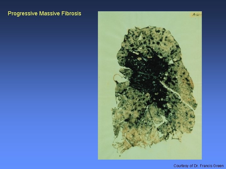 Progressive Massive Fibrosis Courtesy of Dr. Francis Green 