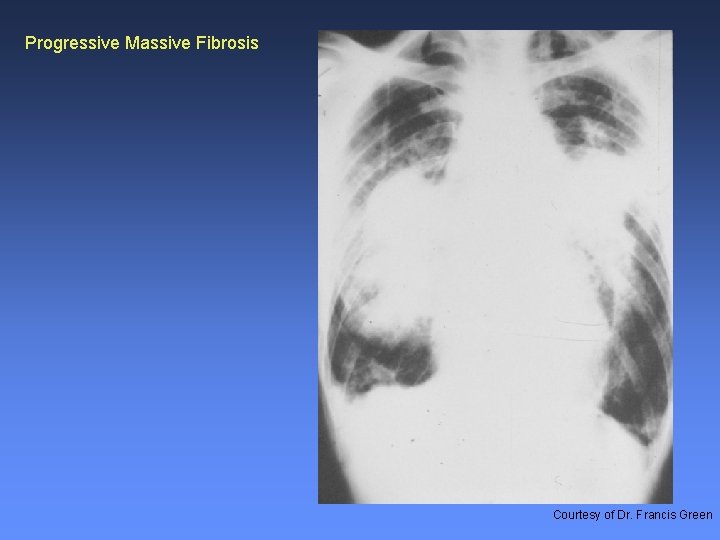 Progressive Massive Fibrosis Courtesy of Dr. Francis Green 