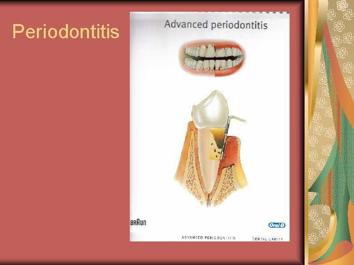 Periodontitis 