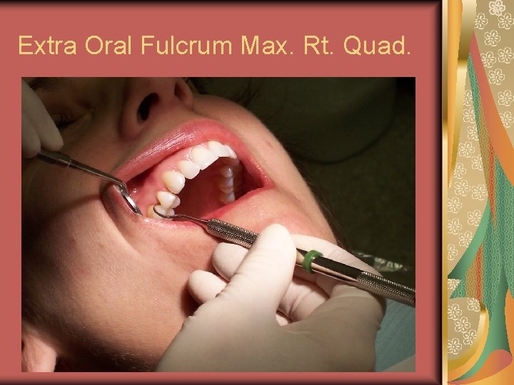 Extra Oral Fulcrum Max. Rt. Quad. 