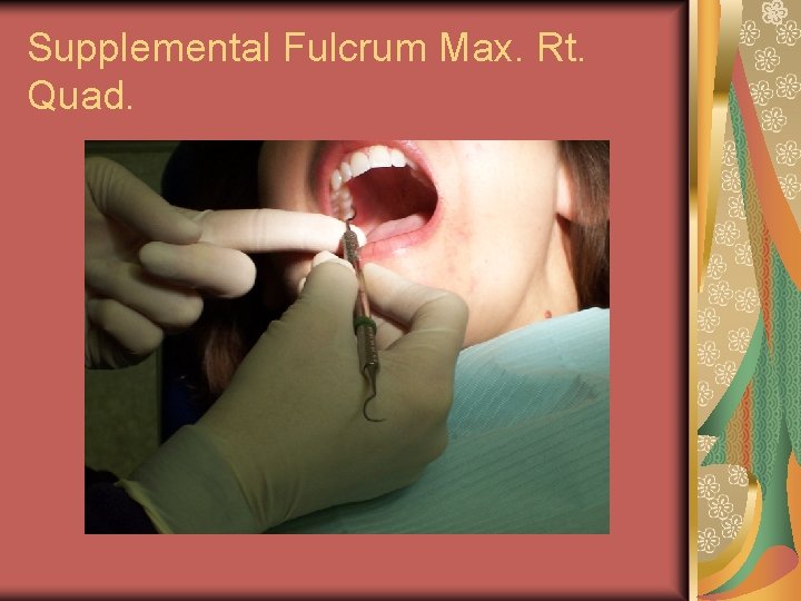 Supplemental Fulcrum Max. Rt. Quad. 