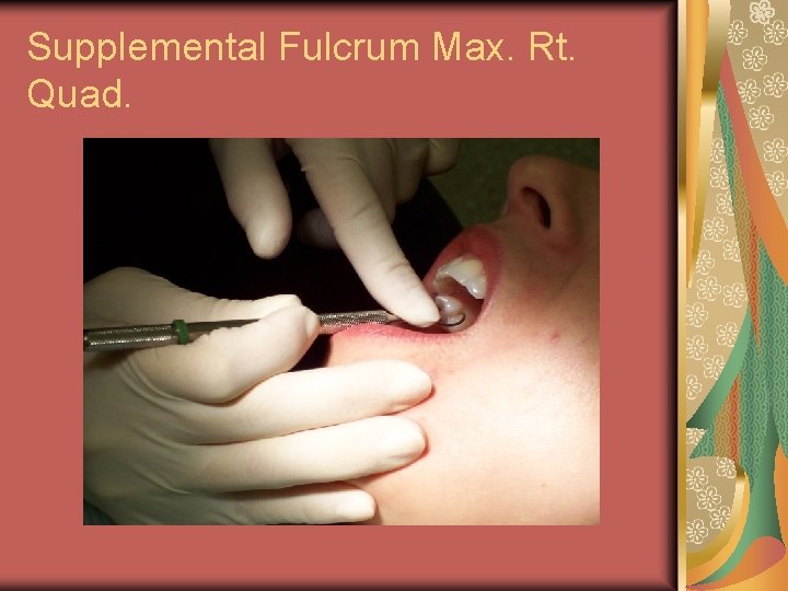 Supplemental Fulcrum Max. Rt. Quad. 