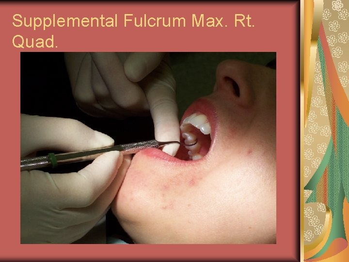 Supplemental Fulcrum Max. Rt. Quad. 