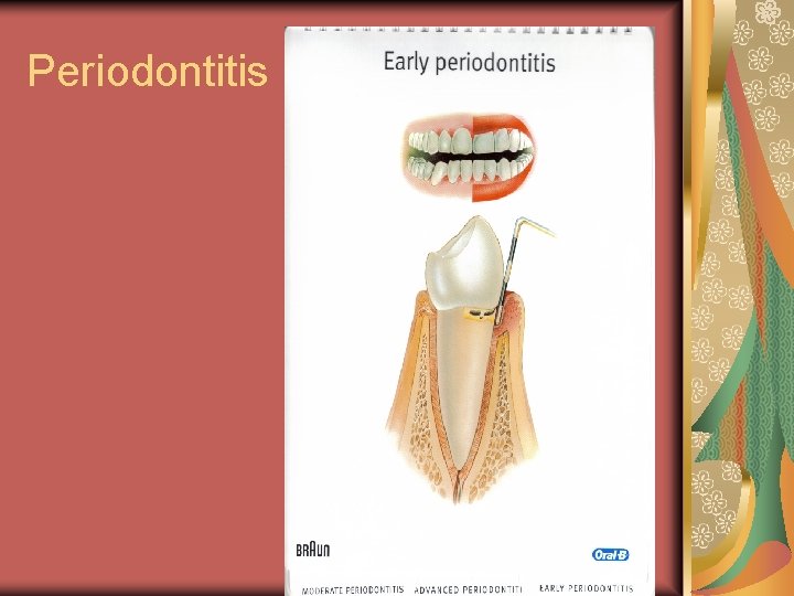 Periodontitis 