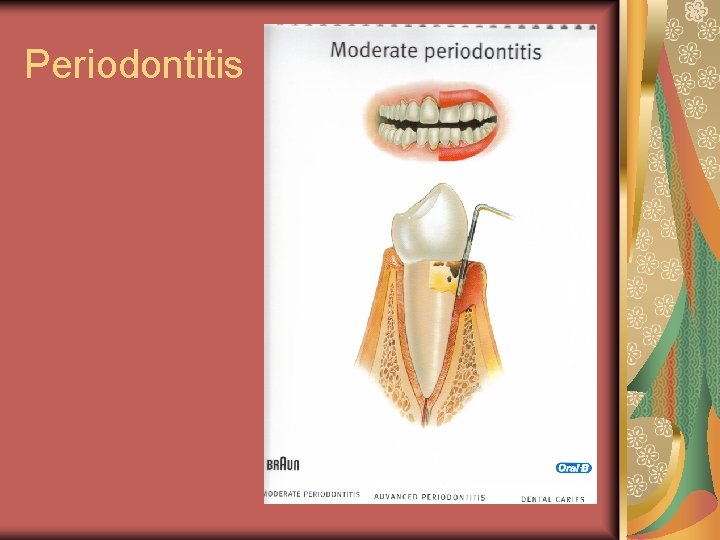 Periodontitis 