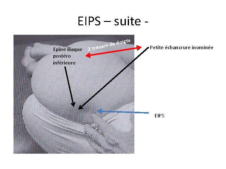 EIPS – suite Epine iliaque postéro inférieure ts 2 trav doig e d s