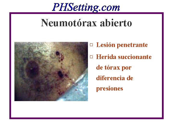 Neumotórax abierto ¤ Lesión penetrante ¤ Herida succionante de tórax por diferencia de presiones Neumotórax abierto ¤ Lesión penetrante ¤ Herida succionante de tórax por diferencia de presiones