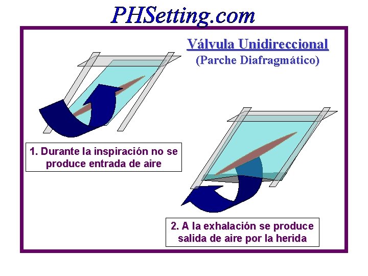 Válvula Unidireccional (Parche Diafragmático) 1. Durante la inspiración no se produce entrada de aire Válvula Unidireccional (Parche Diafragmático) 1. Durante la inspiración no se produce entrada de aire