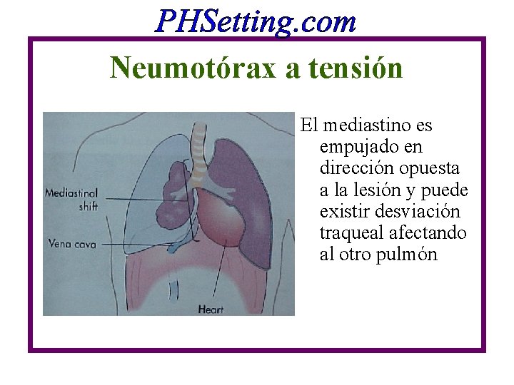 Neumotórax a tensión El mediastino es empujado en dirección opuesta a la lesión y Neumotórax a tensión El mediastino es empujado en dirección opuesta a la lesión y
