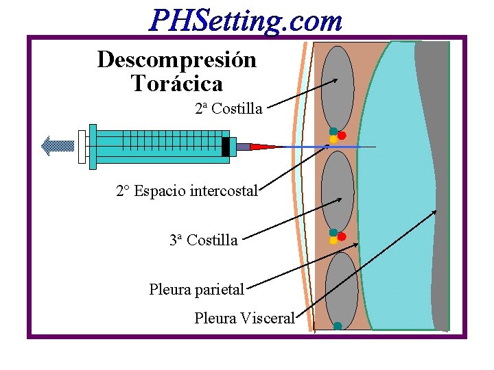 Descompresión Torácica 2ª Costilla 2º Espacio intercostal 3ª Costilla Pleura parietal Pleura Visceral Descompresión Torácica 2ª Costilla 2º Espacio intercostal 3ª Costilla Pleura parietal Pleura Visceral