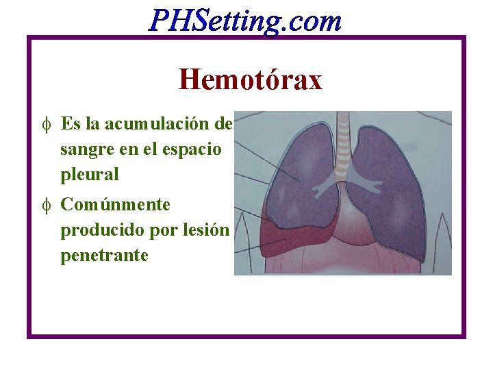 Hemotórax f Es la acumulación de sangre en el espacio pleural f Comúnmente producido Hemotórax f Es la acumulación de sangre en el espacio pleural f Comúnmente producido