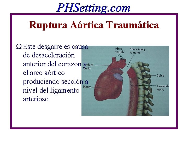 Ruptura Aórtica Traumática W Este desgarre es causa de desaceleración anterior del corazón y Ruptura Aórtica Traumática W Este desgarre es causa de desaceleración anterior del corazón y