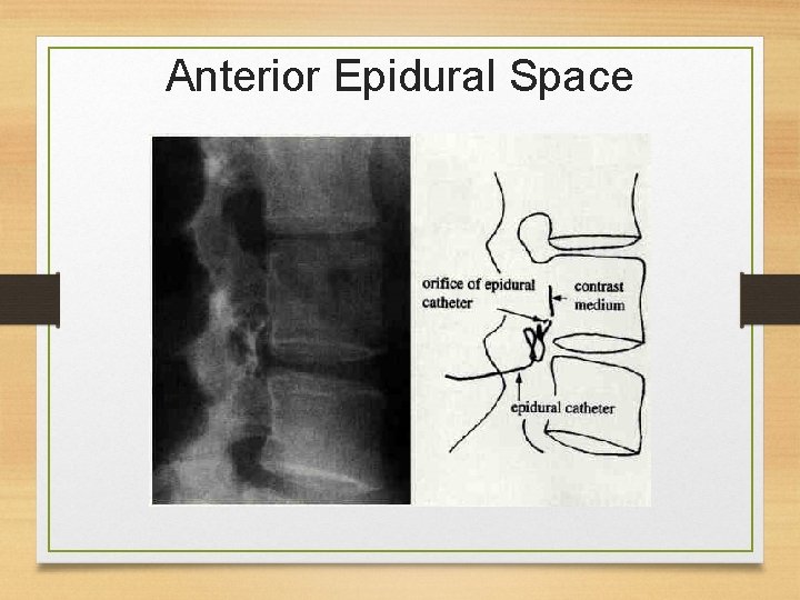 Anterior Epidural Space 