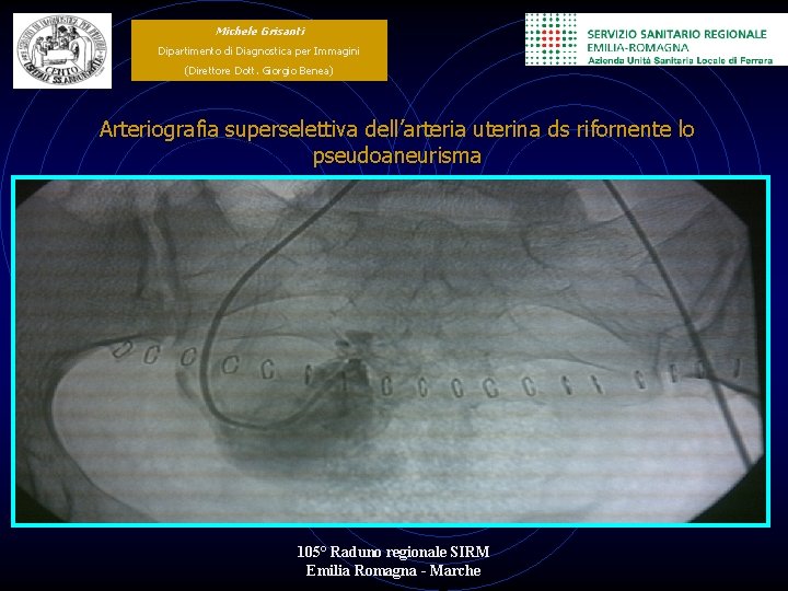 Michele Grisanti Dipartimento di Diagnostica per Immagini (Direttore Dott. Giorgio Benea) Arteriografia superselettiva dell’arteria