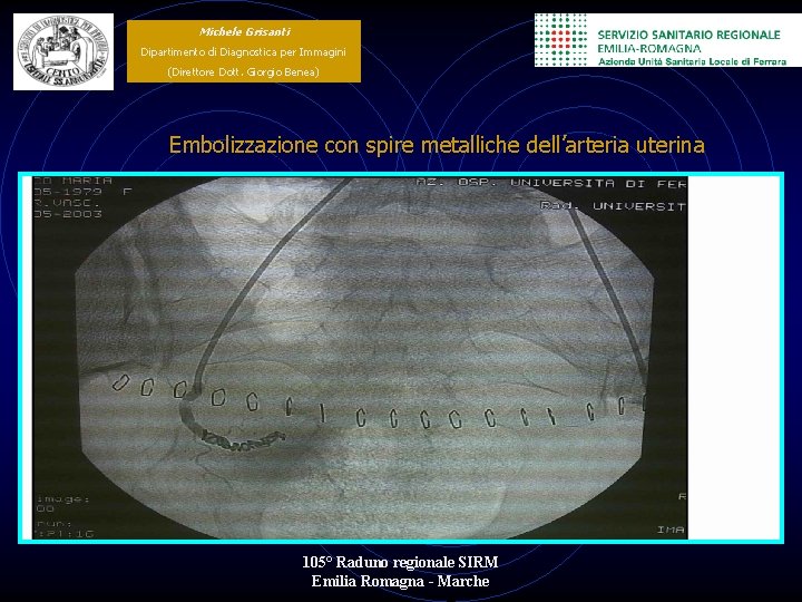 Michele Grisanti Dipartimento di Diagnostica per Immagini (Direttore Dott. Giorgio Benea) Embolizzazione con spire