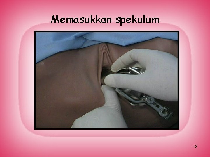 Memasukkan spekulum 18 