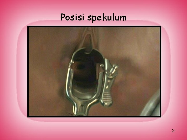 Posisi spekulum 21 