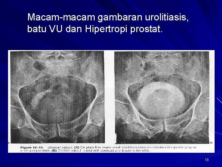 Macam-macam gambaran urolitiasis, batu VU dan Hipertropi prostat. 18 
