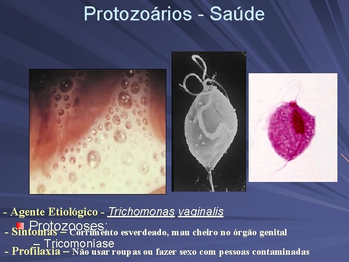 Protozoários - Saúde - Agente Etiológico - Trichomonas vaginalis Protozooses : esverdeado, mau cheiro