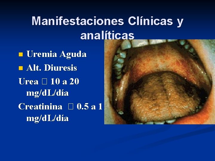 Manifestaciones Clínicas y analíticas Uremia Aguda n Alt. Diuresis Urea 10 a 20 mg/d.