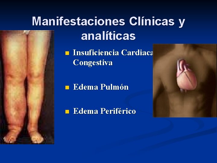 Manifestaciones Clínicas y analíticas n Insuficiencia Cardiaca Congestiva n Edema Pulmón n Edema Periférico