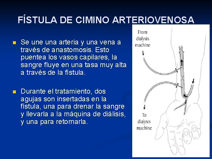 FÍSTULA DE CIMINO ARTERIOVENOSA n Se una arteria y una vena a través de