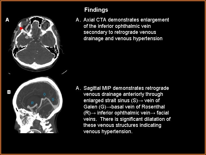 Findings A. Axial CTA demonstrates enlargement of the inferior ophthalmic vein secondary to retrograde