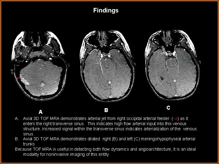 Findings ← → → AA B C A. Axial 3 D TOF MRA demonstrates