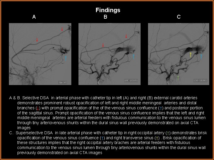 Findings A B C ↓ ↓ ↑ ↑ ↑ A & B. Selective DSA