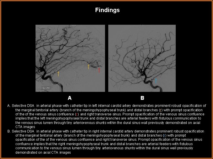 Findings ↑ ↑ AA B A. Selective DSA in arterial phase with catheter tip