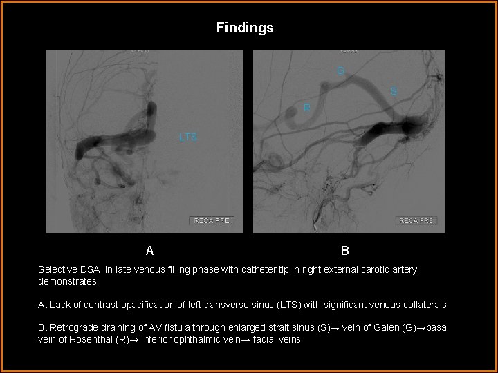 Findings G S R LTS A A B Selective DSA in late venous filling