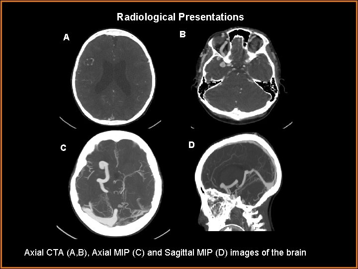 Radiological Presentations A C B D Axial CTA (A, B), Axial MIP (C) and