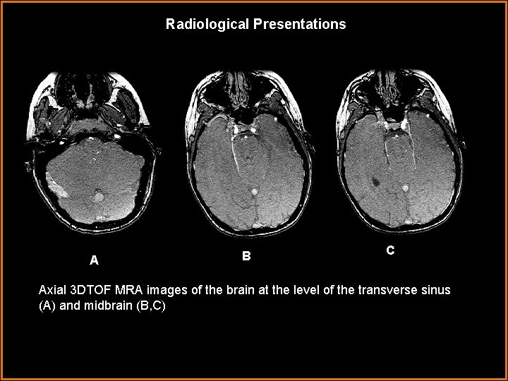 Radiological Presentations AA B C Axial 3 DTOF MRA images of the brain at