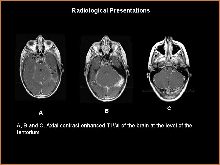 Radiological Presentations AA B C A, B and C. Axial contrast enhanced T 1