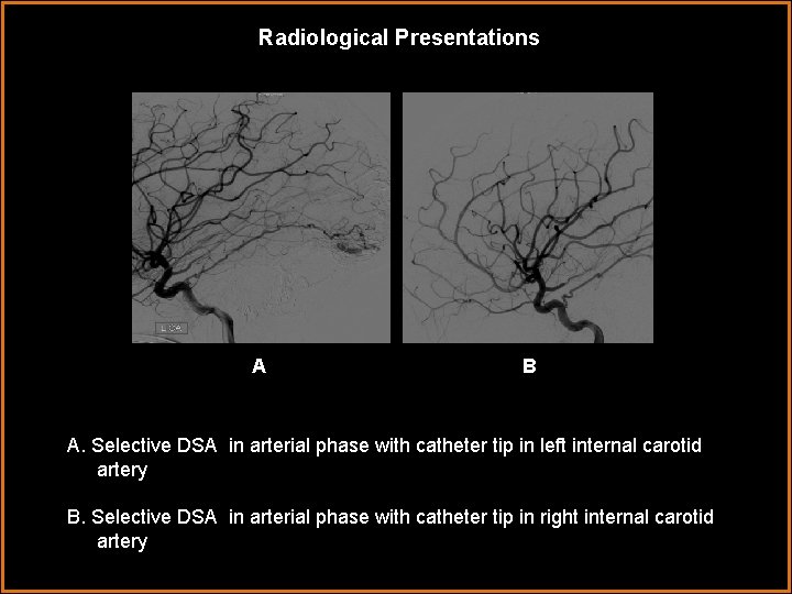Radiological Presentations AA B A. Selective DSA in arterial phase with catheter tip in