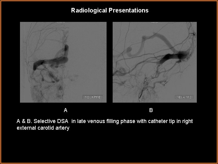 Radiological Presentations A A B A & B. Selective DSA in late venous filling