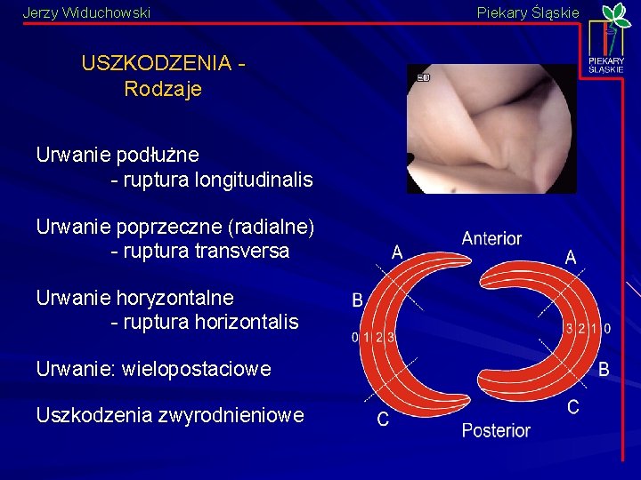 Jerzy Widuchowski USZKODZENIA - Rodzaje Urwanie podłużne - ruptura longitudinalis Urwanie poprzeczne (radialne) -